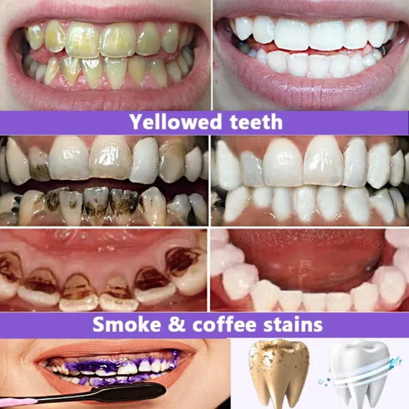 Бестселлер 2026: Отбеливающая  – обзор и цена Teeth Whitening Effective