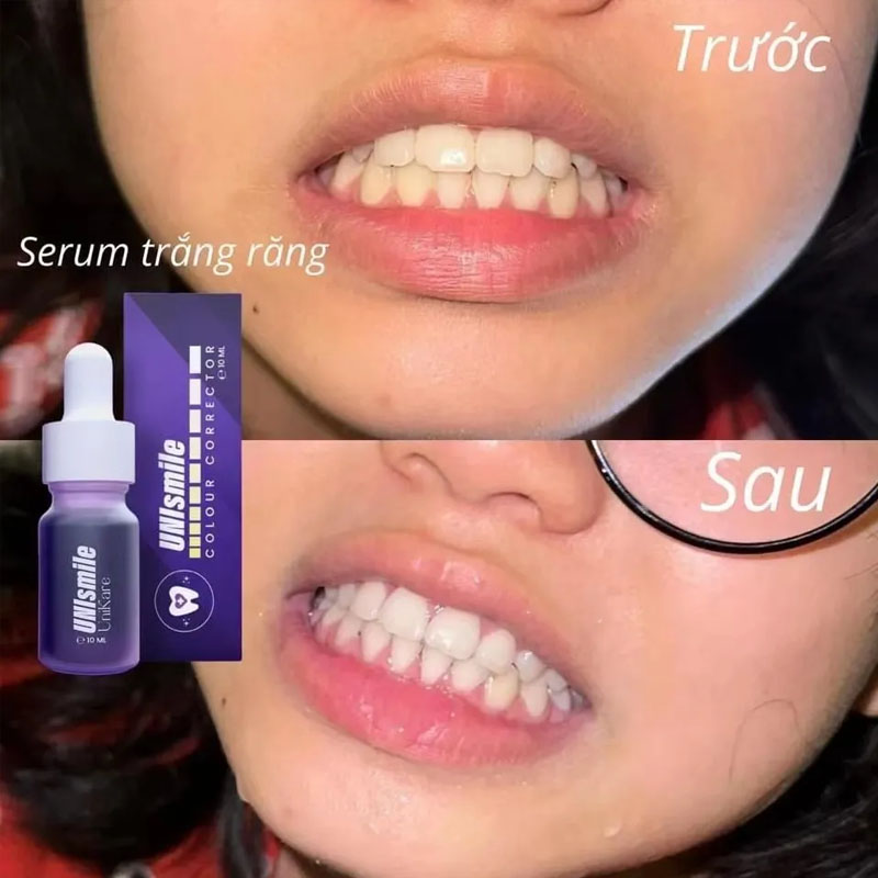 Эссенция для отбеливания зубов – обзор и цена Teeth Whitening Effective