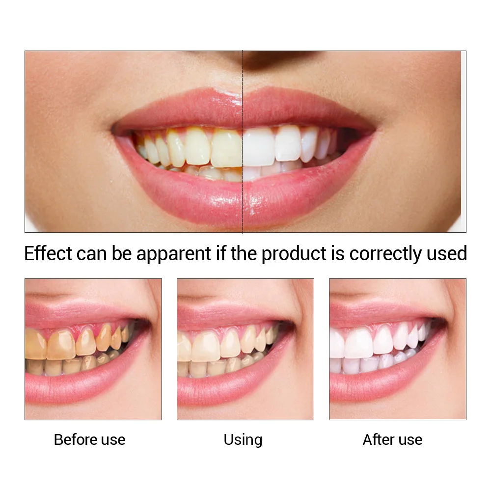 FTEENPLY отбеливание зубов быс – обзор и цена Teeth Whitening Price