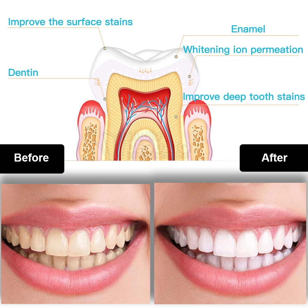 Набор для отбеливания зубов, м – обзор и цена Teeth Whitening With Blue Light